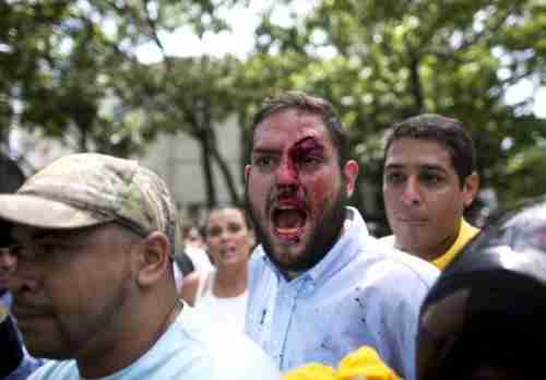 Venezuelan opposition lawmaker Juan Requesens after being bloodied by a Maduro supporter (AP)